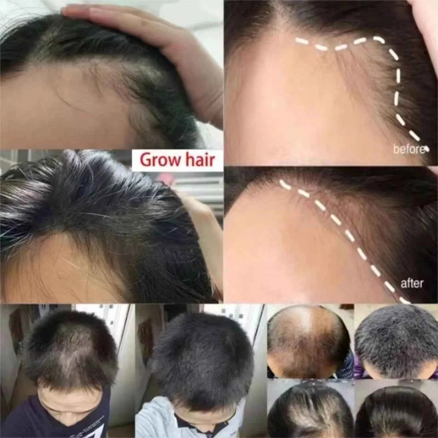 Fast Hair Growth Set Batana Oil Traction Alopecia Hair Mask Anti Break Loss Hair Growth Oil Baldness Treatment Hair Health Care