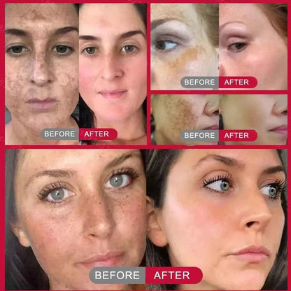 Effective Whitening Freckles Face Cream Dark Spot Corrector Remove Melasma Fade Melanin Pigmentation Brighten Skin Care Products