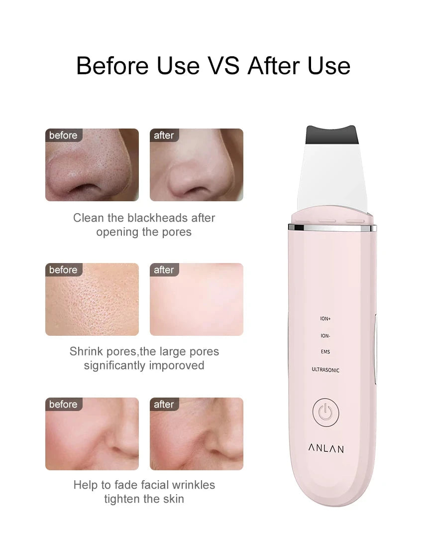 ANLAN Ultrasonic Skin Scrubber Deep Cleaning Peeling Shovel Limpiador Facial Skin Care Face Lifting Machine Ultrasonic Cleaner