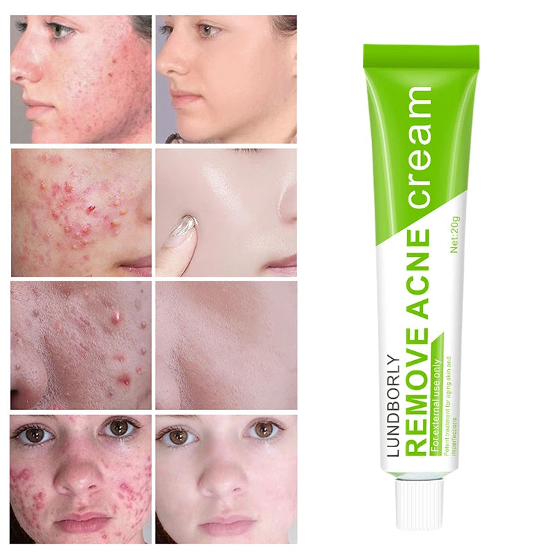 LUNDBORLY Acne Care Cream with Natural Herbal Extracts Helps Soothe Skin Improve Skin Texture and Keep Skin Smooth and Radiant - AMULET RING STORE