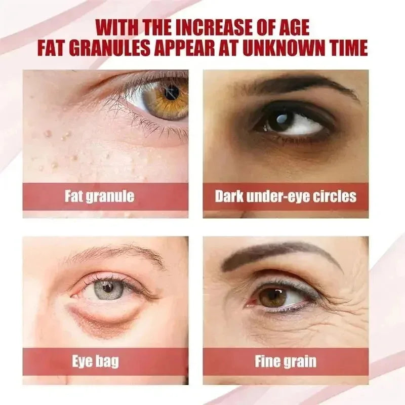 Fat Granules Remover Eye Cream Effective Remove Fat Granules Puffiness Anti-Particles Milia Remover Product Repair Eye Skin Care - AMULET RING STORE