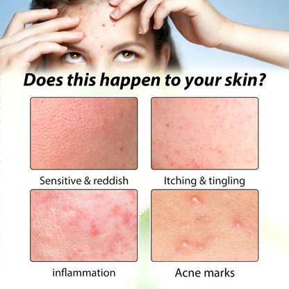 Acne Face Cream Pimple Treatment Oil Control Repair Redness Remove Blackhead Smooth Hydrating Moisturizing Pore Shrinking Serum - AMULET RING STORE