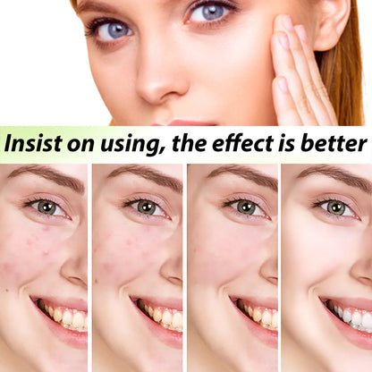 Acne Face Cream Pimple Treatment Oil Control Repair Redness Remove Blackhead Smooth Hydrating Moisturizing Pore Shrinking Serum - AMULET RING STORE