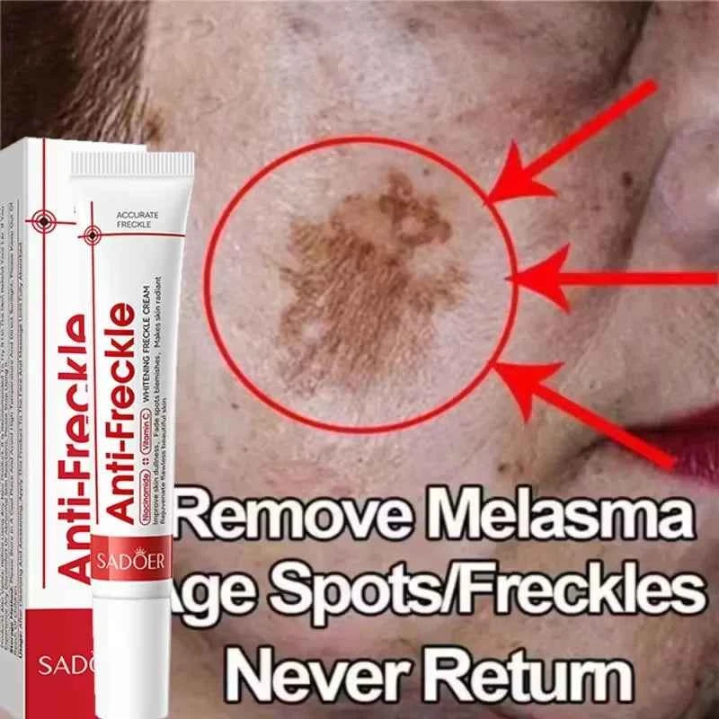 Effective Whitening Freckles Face Cream Dark Spot Corrector Remove Melasma Fade Melanin Pigmentation Brighten Skin Care Products