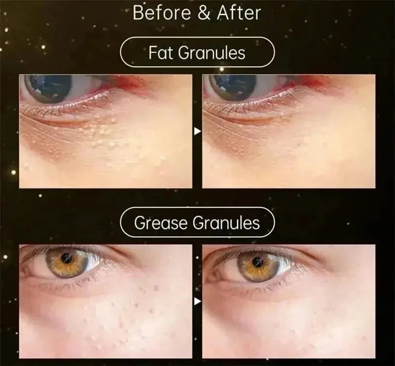 Fat Granules Remover Eye Cream Effective Remove Fat Granules Puffiness Anti-Particles Milia Remover Product Repair Eye Skin Care - AMULET RING STORE
