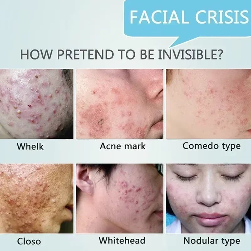 Pore Shrinking Cream Acne Pit Repair Products for Men and Women Remove acne mark scars Large pore anti-inflammatory smooth skin - AMULET RING STORE