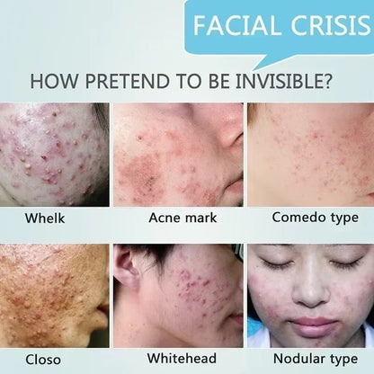 Pore Shrinking Cream Acne Pit Repair Products for Men and Women Remove acne mark scars Large pore anti-inflammatory smooth skin - AMULET RING STORE