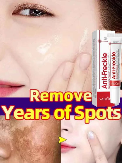 Effective Whitening Freckles Face Cream Dark Spot Corrector Remove Melasma Fade Melanin Pigmentation Brighten Skin Care Products