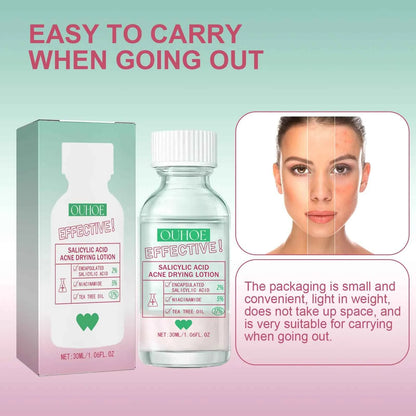 Ouhoe Salicylic Acid Acne Care Lotion Gentle Acne Treatment Pore Shrink Nourishing Improve Skin Texture Glowing Acne Care Lotion