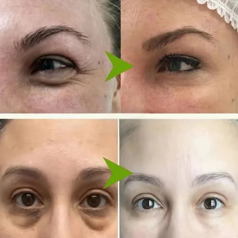 Fat Granules Remover Eye Cream Effective Remove Fat Granules Puffiness Anti-Particles Milia Remover Product Repair Eye Skin Care - AMULET RING STORE