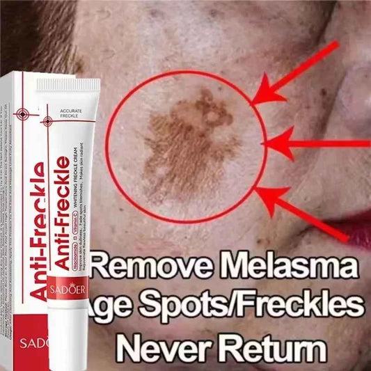 Effective Whitening Freckles Face Cream Dark Spot Corrector Remove Melasma Fade Melanin Pigmentation Brighten Skin Care Products