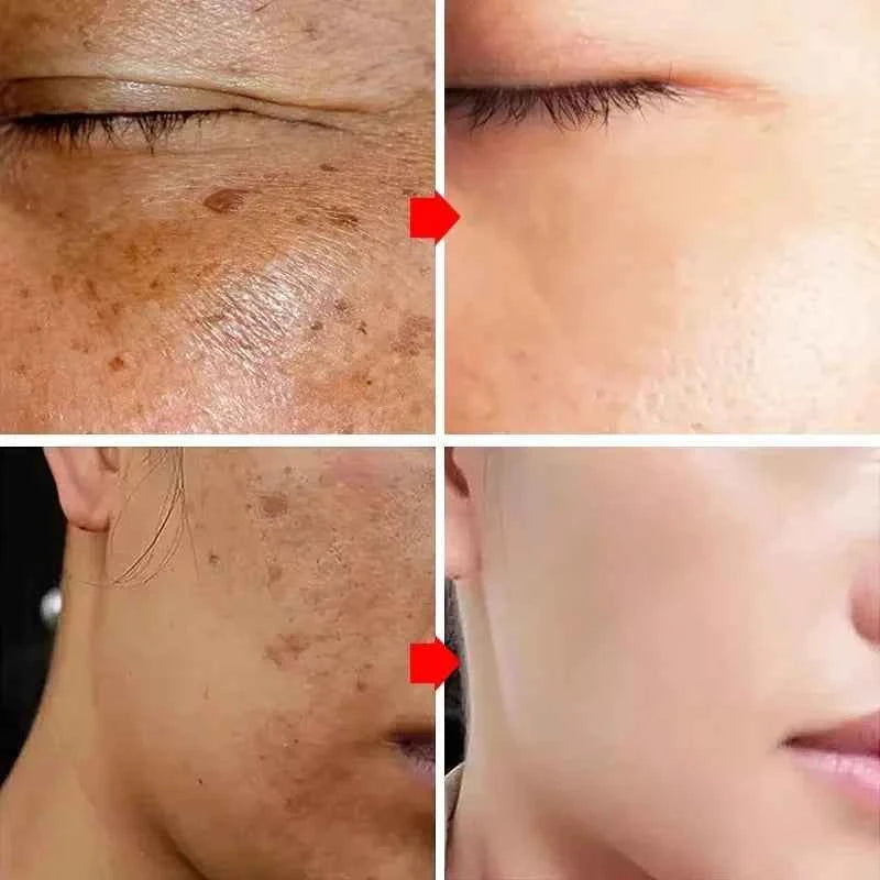 Effective Whitening Freckles Face Cream Dark Spot Corrector Remove Melasma Fade Melanin Pigmentation Brighten Skin Care Products