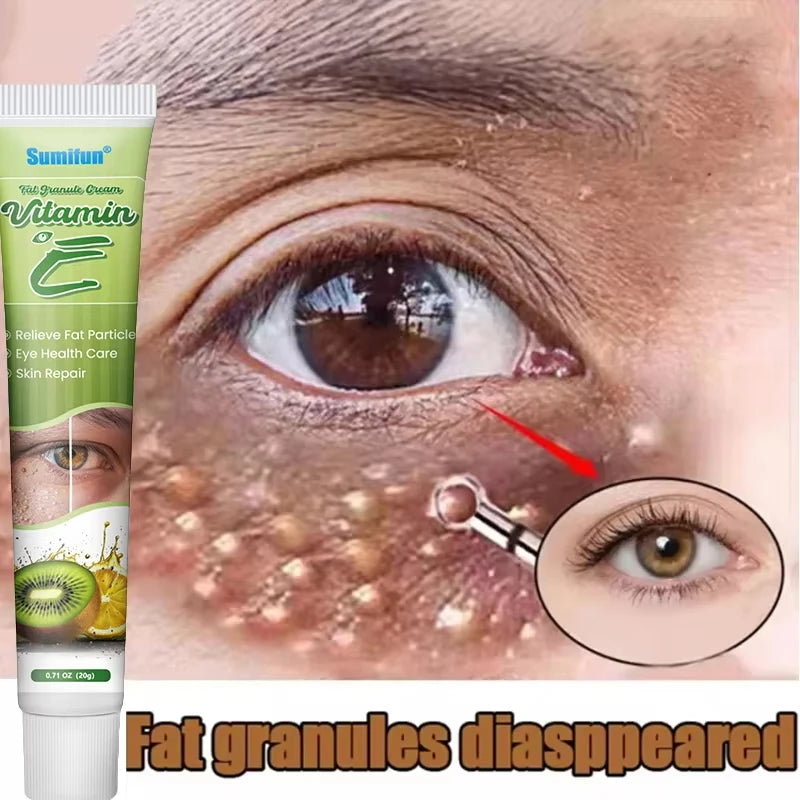 Fat Granules Remover Eye Cream Effective Remove Fat Granules Puffiness Anti-Particles Milia Remover Product Repair Eye Skin Care - AMULET RING STORE