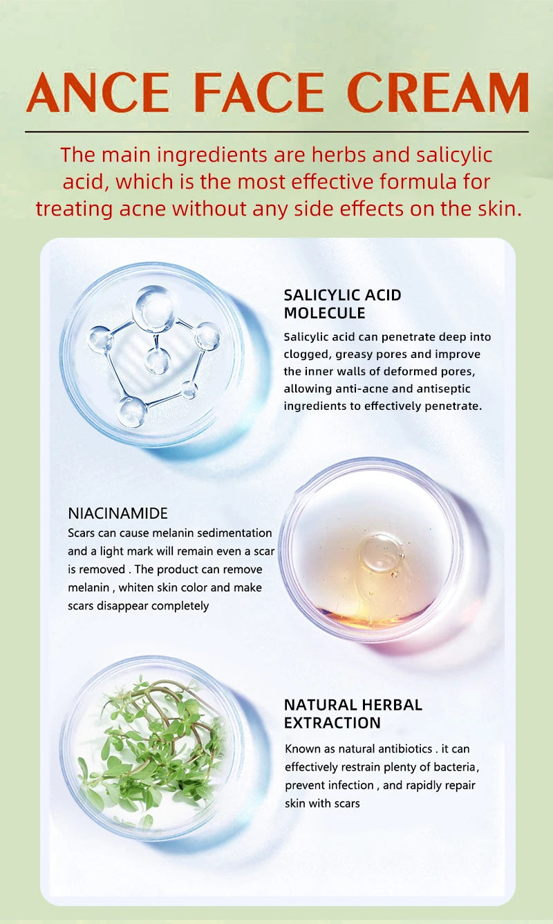 LUNDBORLY Acne Care Cream with Natural Herbal Extracts Helps Soothe Skin Improve Skin Texture and Keep Skin Smooth and Radiant - AMULET RING STORE