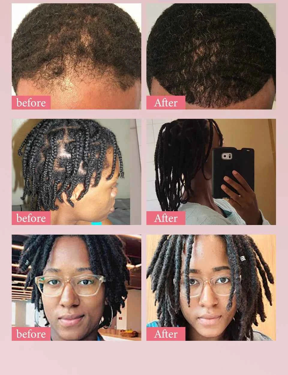 100% Pure Natural KARKAR Butter Hair Growth Oil Anti-Hair Loss Oil Repair Damaged Scalp Treatment Serum Oil For All Hair Types