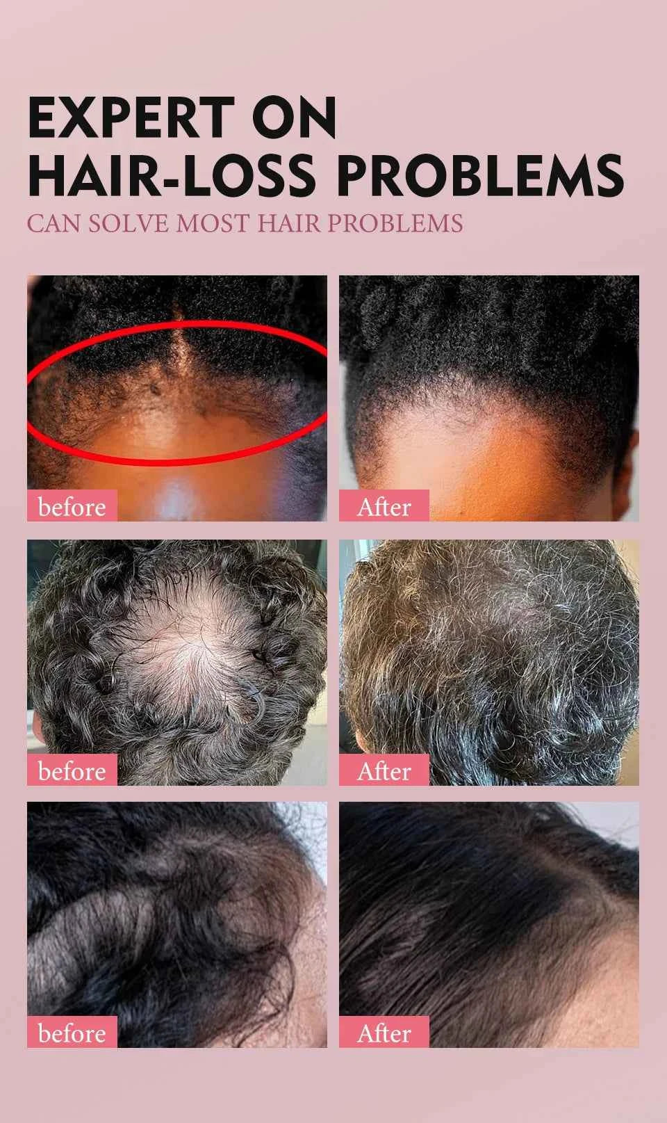 100% Pure Natural KARKAR Butter Hair Growth Oil Anti-Hair Loss Oil Repair Damaged Scalp Treatment Serum Oil For All Hair Types