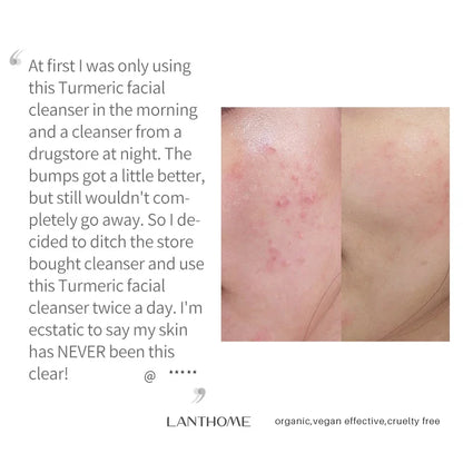 Turmeric lemon Skin Care products Acne Dark Spot Remover Whitening Brighten Facial Serum Face Cream Cleanser Serum Oil Cosmetics