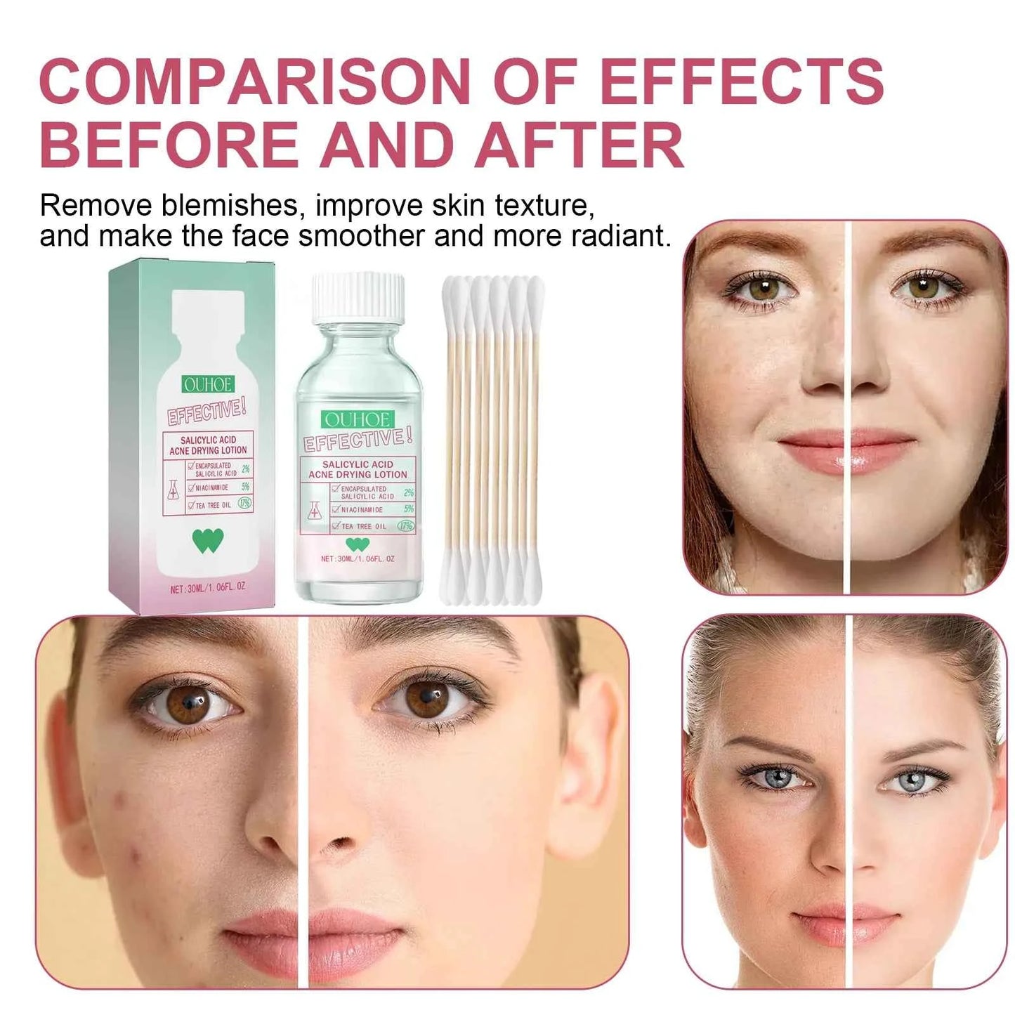 Ouhoe Salicylic Acid Acne Care Lotion Gentle Acne Treatment Pore Shrink Nourishing Improve Skin Texture Glowing Acne Care Lotion