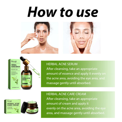 Acne Face Cream Pimple Treatment Oil Control Repair Redness Remove Blackhead Smooth Hydrating Moisturizing Pore Shrinking Serum - AMULET RING STORE