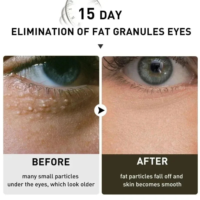 Fat Granules Remover Eye Cream Effective Remove Fat Granules Puffiness Anti-Particles Milia Remover Product Repair Eye Skin Care - AMULET RING STORE