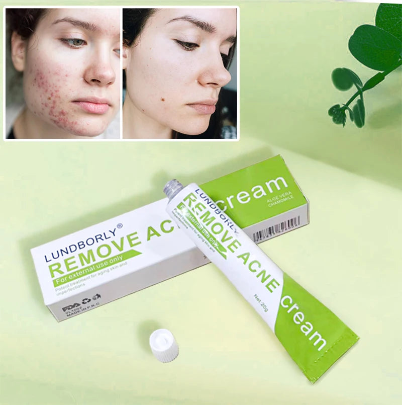 LUNDBORLY Acne Care Cream with Natural Herbal Extracts Helps Soothe Skin Improve Skin Texture and Keep Skin Smooth and Radiant - AMULET RING STORE