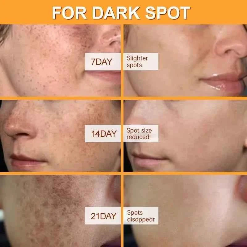 Effective Whitening Freckles Face Cream Dark Spot Corrector Remove Melasma Fade Melanin Pigmentation Brighten Skin Care Products