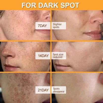 Effective Whitening Freckles Face Cream Dark Spot Corrector Remove Melasma Fade Melanin Pigmentation Brighten Skin Care Products