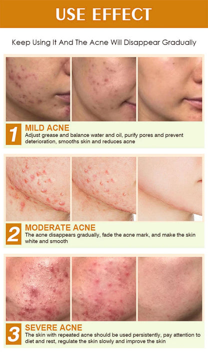 LUNDBORLY Acne Care Cream with Natural Herbal Extracts Helps Soothe Skin Improve Skin Texture and Keep Skin Smooth and Radiant - AMULET RING STORE