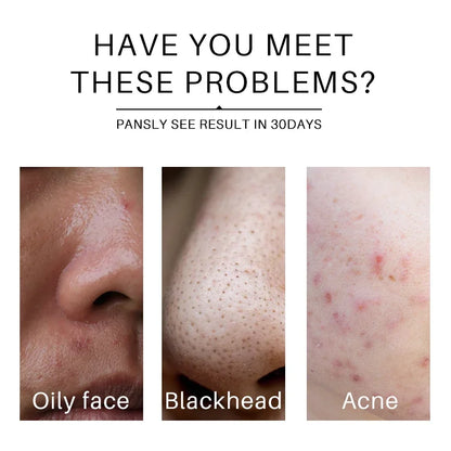 Turmeric lemon Skin Care products Acne Dark Spot Remover Whitening Brighten Facial Serum Face Cream Cleanser Serum Oil Cosmetics