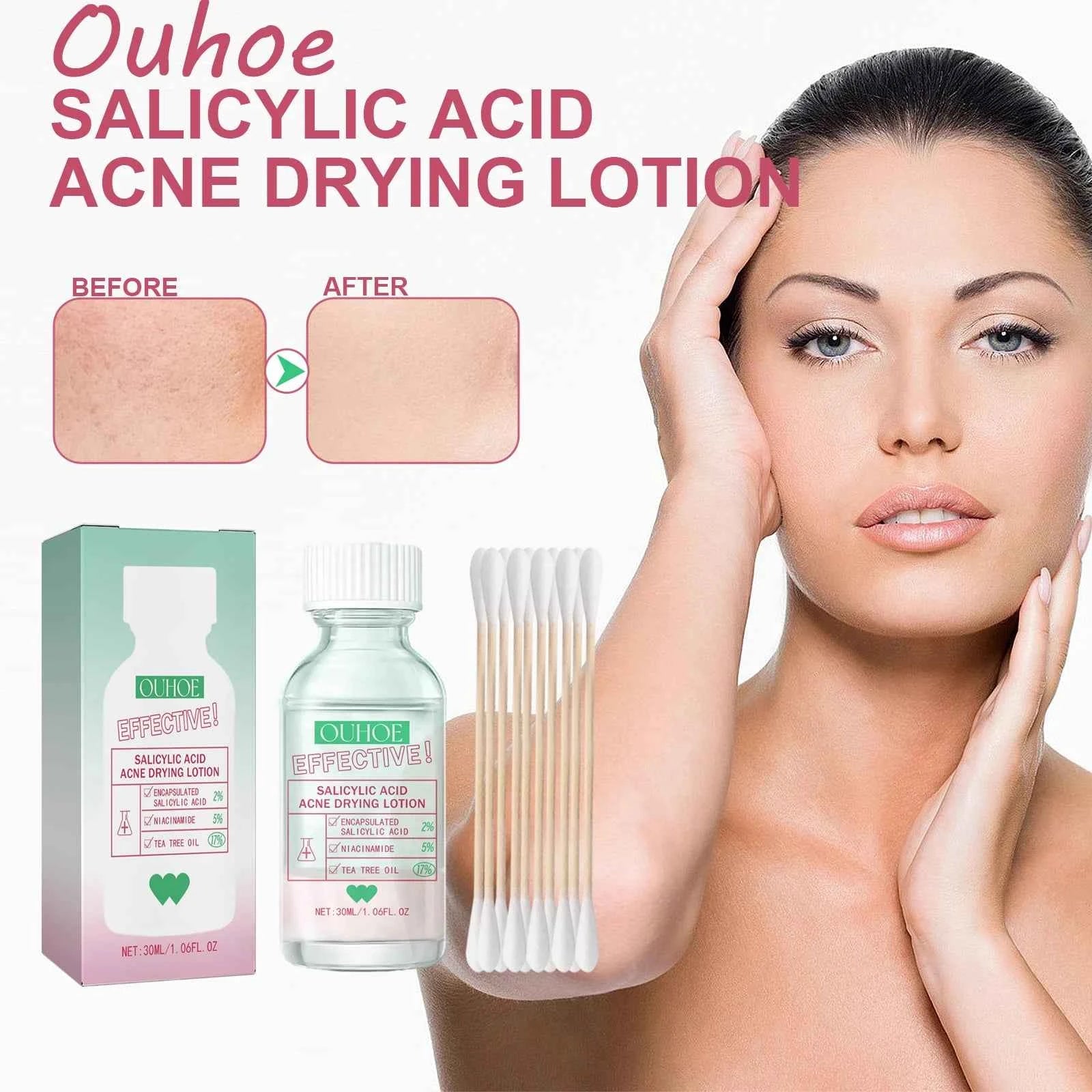 Ouhoe Salicylic Acid Acne Care Lotion Gentle Acne Treatment Pore Shrink Nourishing Improve Skin Texture Glowing Acne Care Lotion