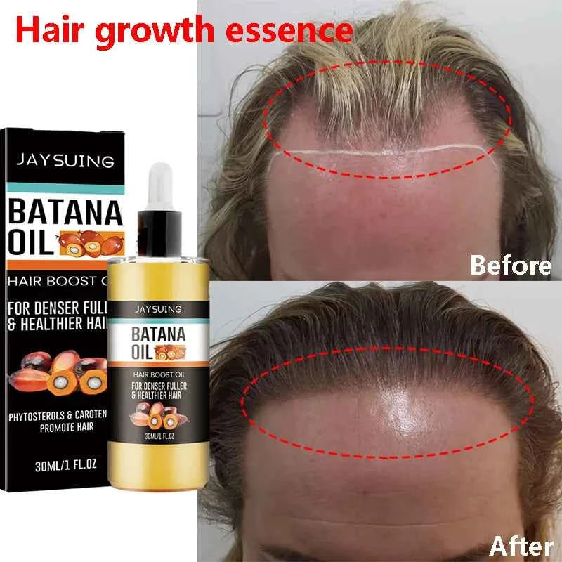 Fast Hair Growth Set Batana Oil Traction Alopecia Hair Mask Anti Break Loss Hair Growth Oil Baldness Treatment Hair Health Care