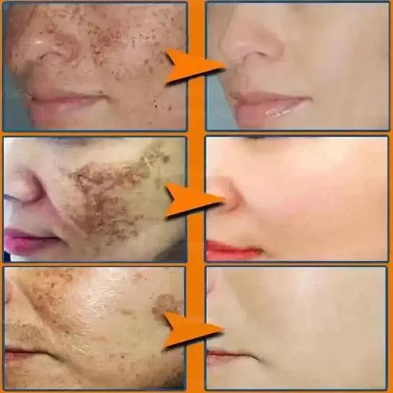 Effective Whitening Freckles Face Cream Dark Spot Corrector Remove Melasma Fade Melanin Pigmentation Brighten Skin Care Products