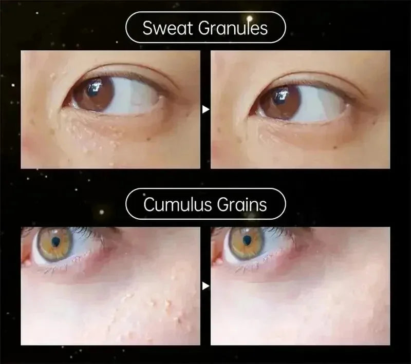 Fat Granules Remover Eye Cream Effective Remove Fat Granules Puffiness Anti-Particles Milia Remover Product Repair Eye Skin Care - AMULET RING STORE