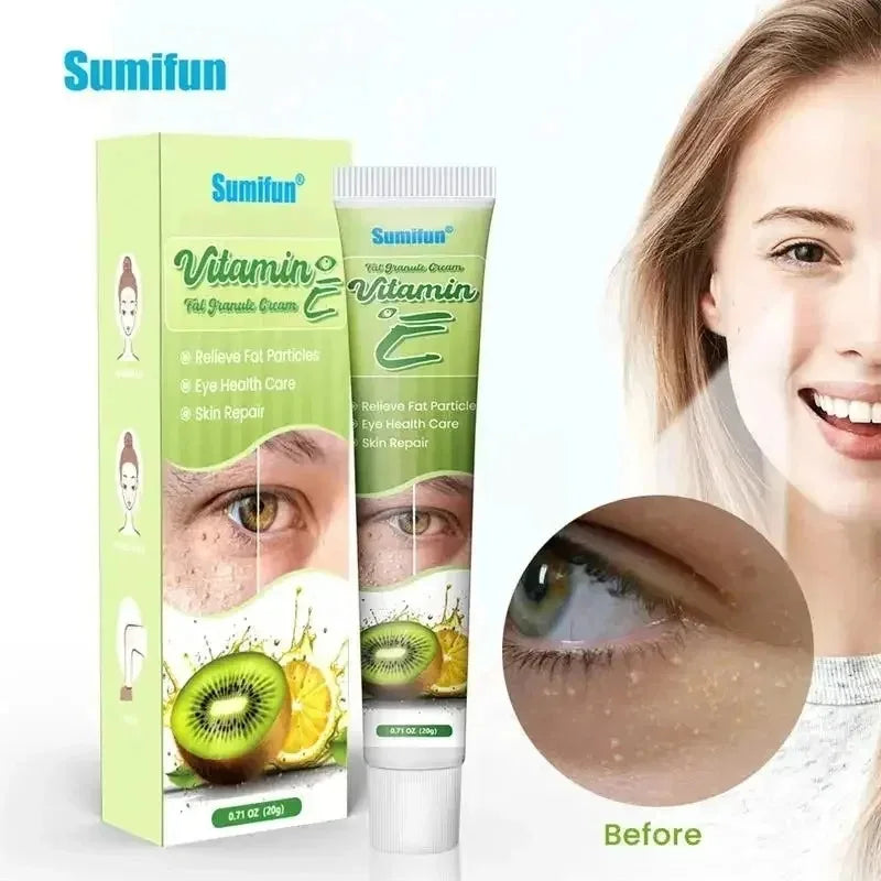 Fat Granules Remover Eye Cream Effective Remove Fat Granules Puffiness Anti-Particles Milia Remover Product Repair Eye Skin Care - AMULET RING STORE